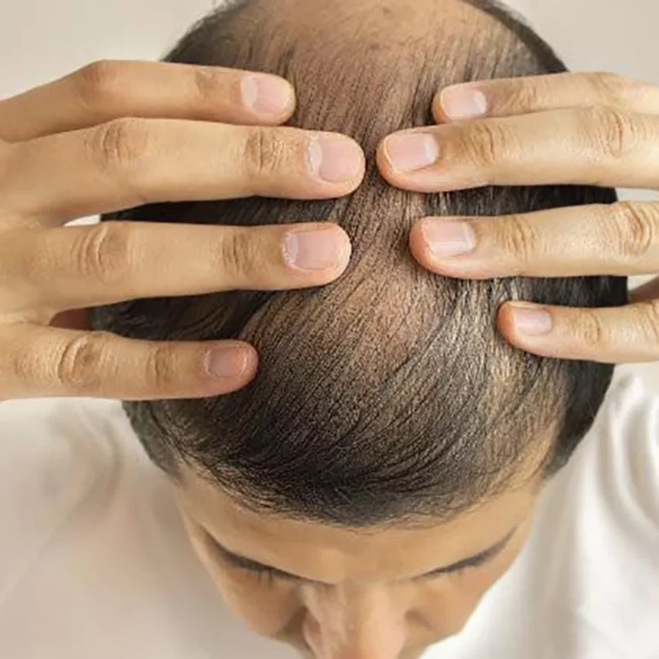 Alopecia: Causas y tratamientos para la pérdida del cabello, una preocupación creciente entre los hombres jóvenes