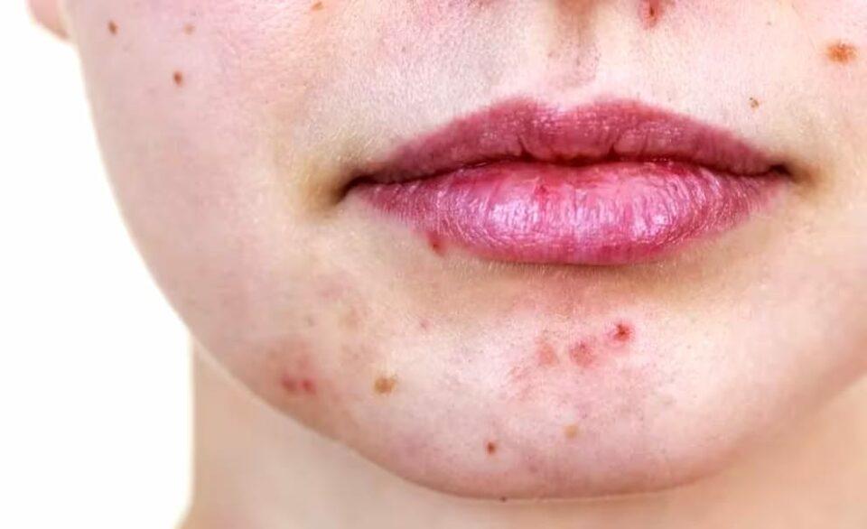 Una dieta cetogénica baja en calorías puede aliviar el acné