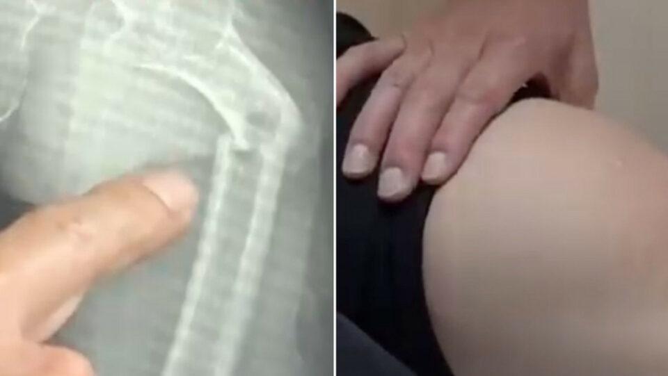 Se rompe el hueso más duro del cuerpo por culpa de una popular bebida