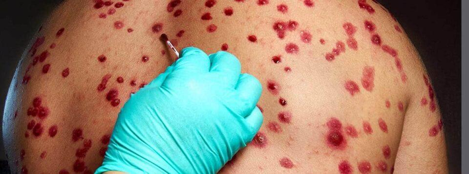 Confirmaron 584 muertes por la viruela del mono en el Congo y la OMS espera más casos en Europa