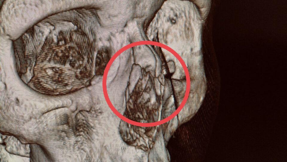 Mujer se fractura la nariz al dormirse con el celular en las manos