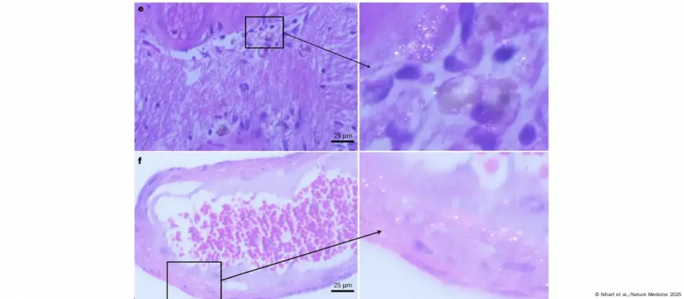 Estudio advierte sobre la acumulación de partículas de plástico en el cerebro