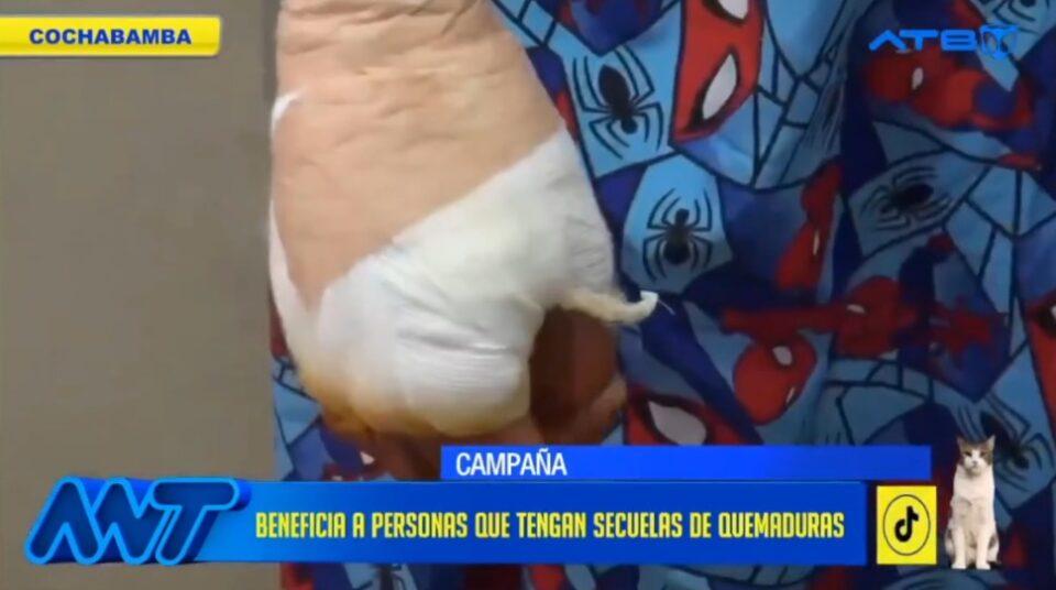 Campaña de cirugías de manos en Cochabamba