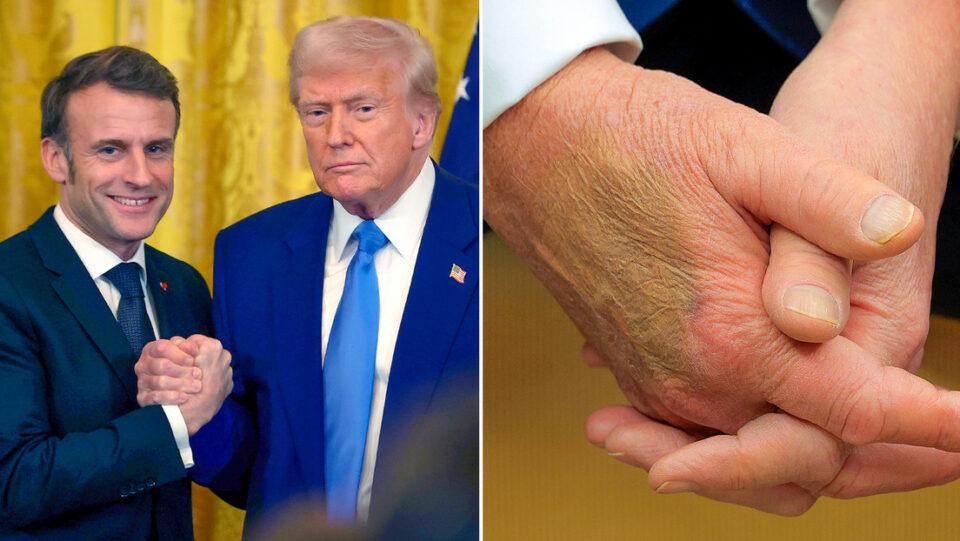 Casa Blanca explica por qué Trump tiene moretones en las manos