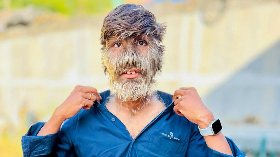 Un joven recibe récord Guinness por ser la persona de la cara más peluda