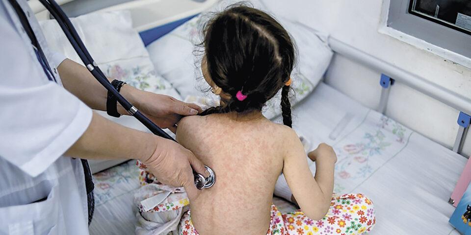 Santa Cruz concentra el 83% de los 125 casos de sarampión en Bolivia