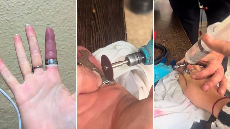 Un equipo de bomberos de Hurlingham salvó el dedo de una joven que había quedado atrapado por un anillo