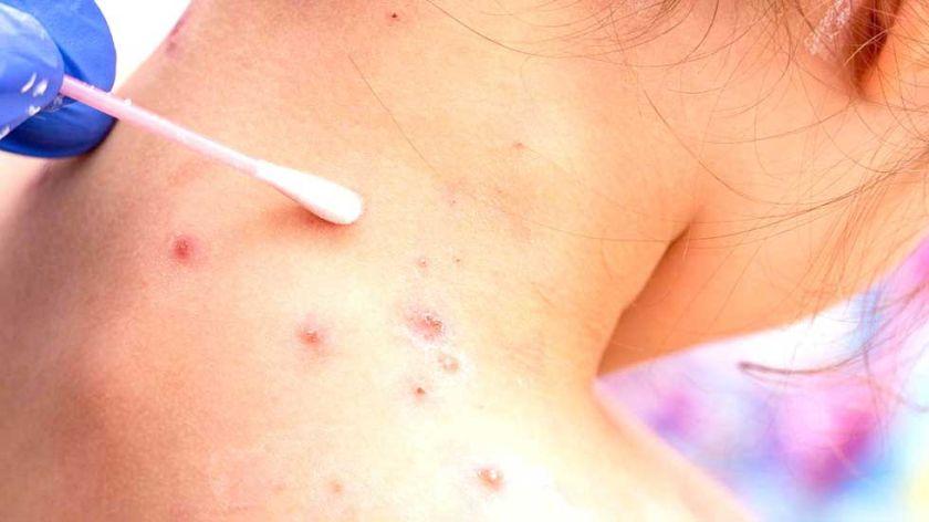 Alerta en Potosí: registran nuevos casos de varicela