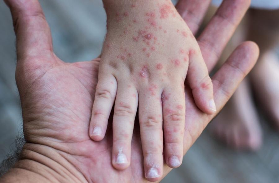 Yacuiba registra segundo caso de sarampión y alerta a padres