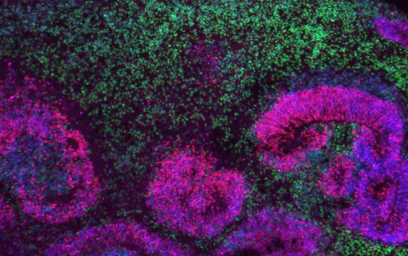 Científicos crean el mapa cerebral más completo para entender el autismo