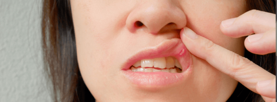 Aftas o llagas en la boca: Conozca las causas y la solución a estas úlceras