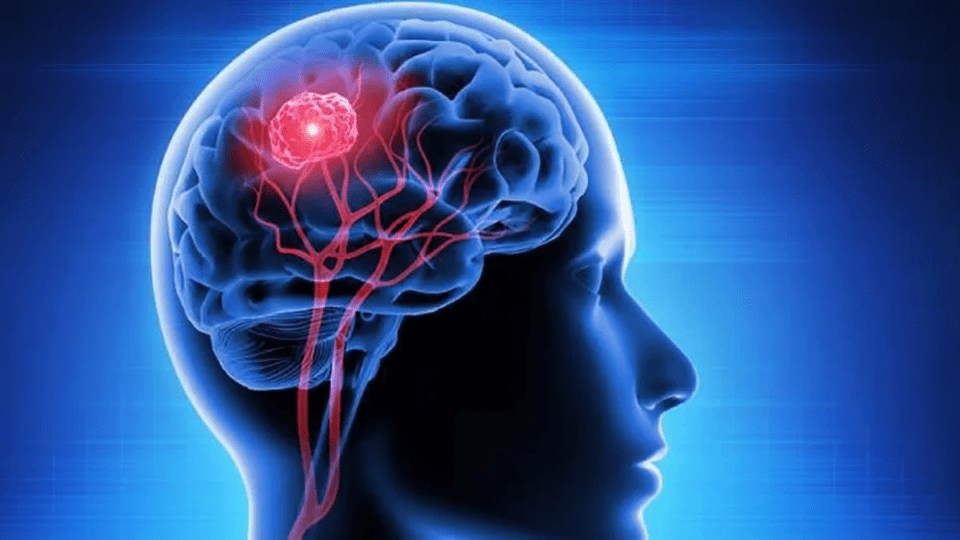 Día Mundial del Tumor Cerebral: La importancia de escuchar las señales de tu cuerpo